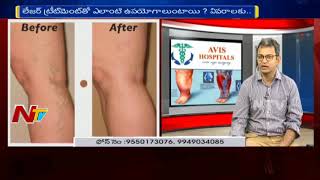 Laser Treatment For Varicose Veins  Varicose Veins  Causes amp Treatment  Hello Doctor  NTV [upl. by Missak]