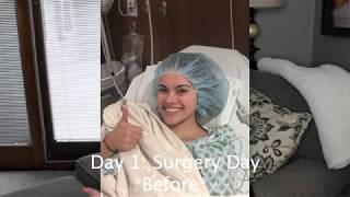 ADULT TONSILLECTOMY SURGERY II DayByDay Recovery the real scoop [upl. by Alverson540]