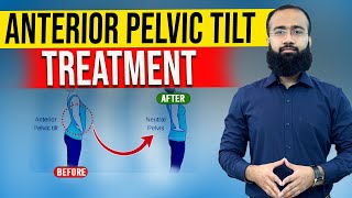 Get Rid Of Anterior Pelvic Tilt Fast With Easy Home Remedies [upl. by Onihc]