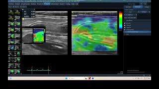 IQ 304 PANCREATIC ULTRASOUND ECHOPAC ANALYSIS ELASTOGRAPHY [upl. by Suoirrad]