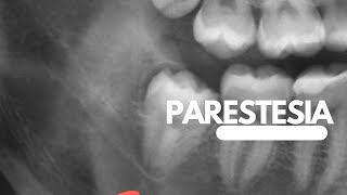 Parestesia dental post extraccion de terceras molares [upl. by Anek]