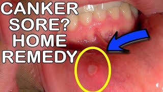 How To Get Rid Of Canker Sores Mouth Ulcer Home Remedy [upl. by Katha818]