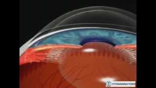 GLAUCOMA DE ANGULO CERRADO E IRIDOTOMIA LASER [upl. by Merrie326]