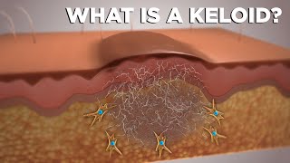 WHAT IS A KELOID [upl. by Natsyrk]