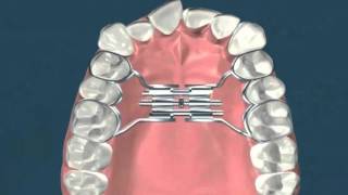 Expasion palatina rapida  Ortodoncia [upl. by Cathee]