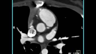 Cardiac Occluded RIMA Graft in a patient with bypass for aberrant coronary artery 2 of 4 [upl. by Alyss287]