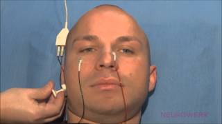 Motoric Neurography  Facial Nerve [upl. by Echo]