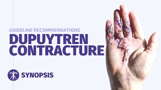 Dupuytrens Contracture Guideline  SYNOPSIS [upl. by Linzy]