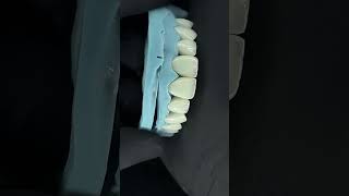 Crowns lithium disillicate ceramotion lisi incisal cut back layered with porcelain ceramotion Zr [upl. by Llertrac]