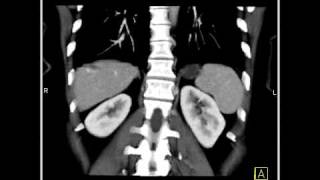 Abdomen Liver Hemangioma of the Liver7 of 8 [upl. by Ardnuahs923]