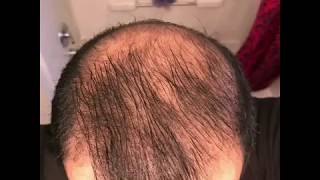 5 months using minoxidil  Rogaine 5 Before amp After results [upl. by Anor]