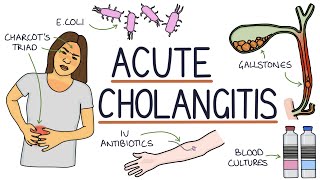 Understanding Acute Cholangitis Ascending Cholangitis [upl. by Aikrahs]