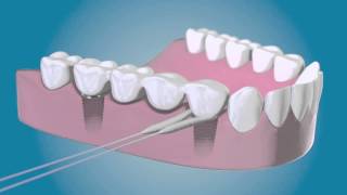 TePe Bridge amp Implant Floss  für die Reinigung um die Implantate [upl. by Marder]