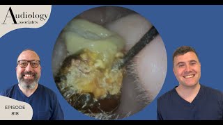 EAR WAX REMOVAL COMPILATION INC TYMPANIC MEMBRANE RETRACTION POCKETS EP818 [upl. by Nappy]