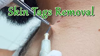 Remove Skin tag  Plasmage ® [upl. by Fedora730]