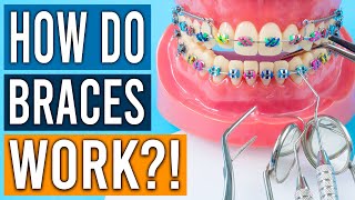 How Do Braces Work [upl. by Mirak]