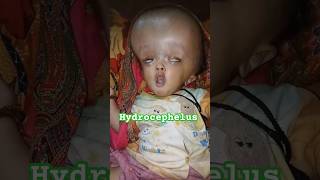 Hydrocephalus  Water on the Brain  बड़ा सिर वाला [upl. by Avahc]