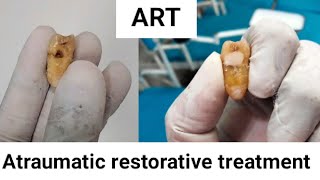 Atraumatic restorative treatment session community dentistry [upl. by Lacy494]