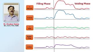 Urodynamic study of voiding phase of bladder [upl. by Cherrita]