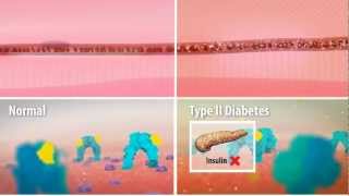 Insulin Resistance in Type 2 Diabetes [upl. by Llenyt]