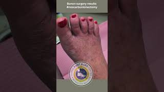 Bunion Surgery  Lam Bunionectomy [upl. by Parlin]