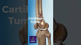 Cartilage Tumor 3D Animation shorts [upl. by Submuloc]