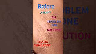 ARMPIT UNDERARM ALL PROBLEM ONE SOLUTION 15 DAYS CHALLENGE 💯  RESULT WITHOUT ANY SIDEEFFECT [upl. by Lehman]