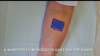 Vidéo d’explication du ROAT gant [upl. by Notloc]