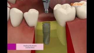 OSSTEM IMPLANT TSIII System Surgical Procedure Taper Kit and Straight Drill Kit [upl. by Arihat772]