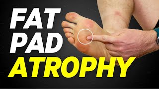 Fat Pad Atrophy  Heel Fad Atrophy and Ball of Foot Atrophy [upl. by Malvie]