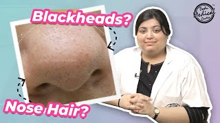 Nose Hair or Blackheads  How to Remove Nose Hair  Trichostasis Spinulosa [upl. by Aihseuqal]