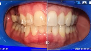 Invisalign treatment before and after with Virtual tracking time lapse [upl. by Mcgean]