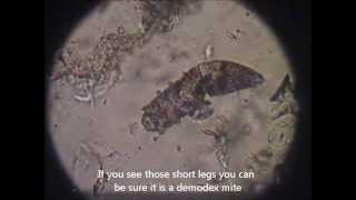 How to recognise demodex mites [upl. by Alberto]