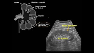 Fetal lobulation of kidney 신장의 태아 분엽 [upl. by Ettezzil178]