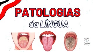 LIQUEN PLANO  LEUCOPLASIA ORAL  LÍNGUA FISSURADA PILOSA E GEOGRÁFICA [upl. by Wiebmer]