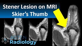 Stener Lesion Skiers Thumb on MRI [upl. by Waring]