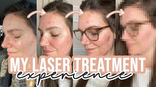 LaseMD Laser Treatment Before amp After  Fixing My Skin  Sarah Brithinee [upl. by Laehcor]