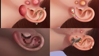 ASMR Ear piercing infection treatmentcleaning ear stone [upl. by Terena]