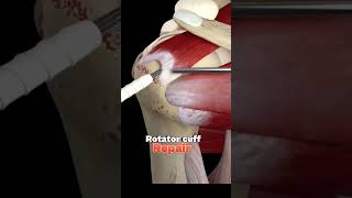 Rotator cuff tear repair surgery animation  Medical animation [upl. by Mazman]