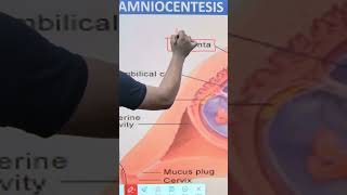 AMNIOCENTESIS  CLASS 12th BIOLOGY  NEET CBSE BOARD BY  Dr SHUBHAM SINGH IMS BHUshorts [upl. by Mehitable]