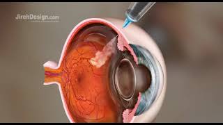 Intravitreal Injection Animation HD [upl. by Kingsley]