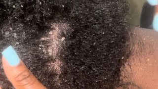 Scalp Scratching  Dandruff Removal  Big Flakes [upl. by Tutankhamen]