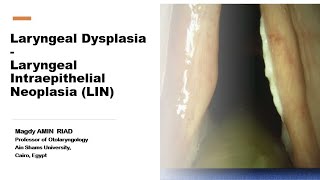 Laryngeal Intraepithelial NeoplasiaLIN Laryngeal Dysplasia [upl. by Arotal]