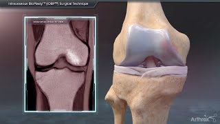 Intraosseous BioPlasty™ IOBP Surgical Technique [upl. by Leahsim]