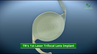 1st Laser Trifocal Lens Implant in Tennessee [upl. by Treharne962]