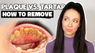 Plaque vs Tartar  How To Remove Plaque From Teeth [upl. by Reahard]