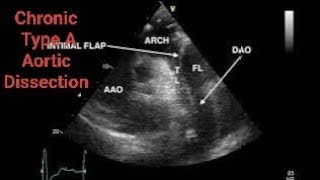 Chronic Type A Aortic Dissection CTAD Echocardiography post AVR [upl. by Phene560]