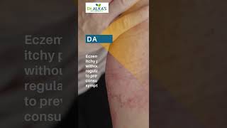 What Are the Early Signs of Eczema Recognize and Manage Symptoms Early [upl. by Razatlab]