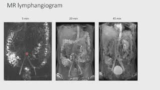 Localised Amyloidosis A rare condition but better outcome CPC aiimsjodhpur [upl. by Araiek]