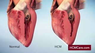 Hypertrophic Cardiomyopathy HCM Mechanism of Disease Video [upl. by Juxon]